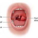 Peritonsillar Abscess