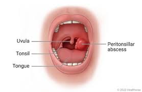 Peritonsillar Abscess