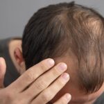 Alopecia and Homeopathy