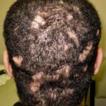 Scarring Alopecia