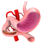 Dyspepsia (Indigestion)