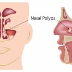 Nasal Polyp