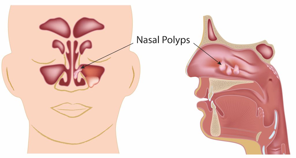 Nasal Polyp