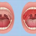 pharyngitis