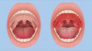 pharyngitis